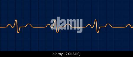 Abbildung eines Elektrokardiogramms (EKG) mit einem Schenkelblock. Dies tritt auf, wenn das elektrische Signal, das das Herz schlägt, durch etwas blockiert oder gestört wird. Das EKG zeigt erweiterte QRS-Komplexe und eine veränderte ventrikuläre Depolarisation. Stockfoto