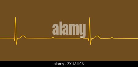 Abbildung eines Elektrokardiogramms (EKG) mit Darstellung eines kompletten Herzblocks (3. Atrioventrikulärer Block). Das EKG zeigt eine vollständige Dissoziation zwischen dem Vorhof- und dem Ventrikelrhythmus. Stockfoto