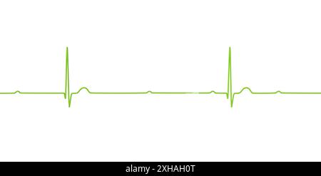 Abbildung eines Elektrokardiogramms (EKG) mit Darstellung eines kompletten Herzblocks (3. Atrioventrikulärer Block). Das EKG zeigt eine vollständige Dissoziation zwischen dem Vorhof- und dem Ventrikelrhythmus. Stockfoto