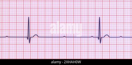 Abbildung eines Elektrokardiogramms (EKG) mit Darstellung eines kompletten Herzblocks (3. Atrioventrikulärer Block). Das EKG zeigt eine vollständige Dissoziation zwischen dem Vorhof- und dem Ventrikelrhythmus. Stockfoto