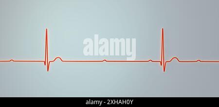 Abbildung eines Elektrokardiogramms (EKG) mit Darstellung eines kompletten Herzblocks (3. Atrioventrikulärer Block). Das EKG zeigt eine vollständige Dissoziation zwischen dem Vorhof- und dem Ventrikelrhythmus. Stockfoto