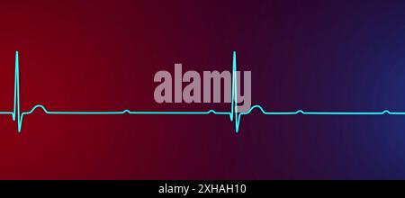 Abbildung eines Elektrokardiogramms (EKG) mit Darstellung eines kompletten Herzblocks (3. Atrioventrikulärer Block). Das EKG zeigt eine vollständige Dissoziation zwischen dem Vorhof- und dem Ventrikelrhythmus. Stockfoto