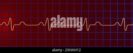 Abbildung eines Elektrokardiogramms (EKG) mit einem Schenkelblock. Dies tritt auf, wenn das elektrische Signal, das das Herz schlägt, durch etwas blockiert oder gestört wird. Das EKG zeigt erweiterte QRS-Komplexe und eine veränderte ventrikuläre Depolarisation. Stockfoto