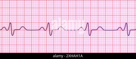 Abbildung eines Elektrokardiogramms (EKG) mit einem Schenkelblock. Dies tritt auf, wenn das elektrische Signal, das das Herz schlägt, durch etwas blockiert oder gestört wird. Das EKG zeigt erweiterte QRS-Komplexe und eine veränderte ventrikuläre Depolarisation. Stockfoto