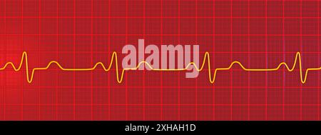 Abbildung eines Elektrokardiogramms (EKG) mit einem Schenkelblock. Dies tritt auf, wenn das elektrische Signal, das das Herz schlägt, durch etwas blockiert oder gestört wird. Das EKG zeigt erweiterte QRS-Komplexe und eine veränderte ventrikuläre Depolarisation. Stockfoto