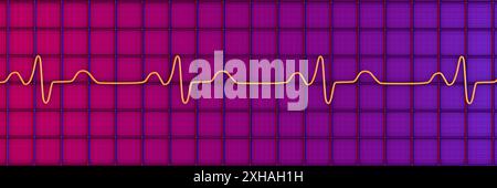 Abbildung eines Elektrokardiogramms (EKG) mit einem Schenkelblock. Dies tritt auf, wenn das elektrische Signal, das das Herz schlägt, durch etwas blockiert oder gestört wird. Das EKG zeigt erweiterte QRS-Komplexe und eine veränderte ventrikuläre Depolarisation. Stockfoto