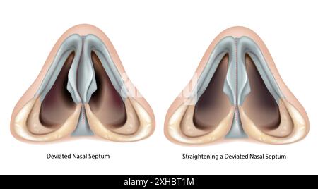 Das abgewandelte Nasenseptum und das Aufrichten eines abgewandelten Nasenseptums. Stock Vektor