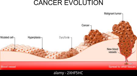 Krebsentwicklung von mutierten Zellen und Hyperplasien zu Dysplasie und malignem Tumor. Krebszellen auf andere Gewebe ausbreiten. Vektordiagramm Stock Vektor