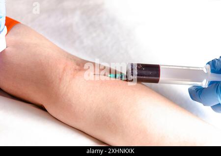 Blutentnahme zur Analyse. Die Hände der Schwester mit einer Spritze mit Handschuhen. Stockfoto