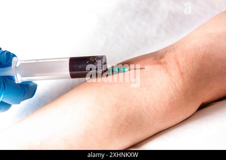 Blutentnahme zur Analyse. Die Hände der Schwester mit einer Spritze mit Handschuhen. Stockfoto