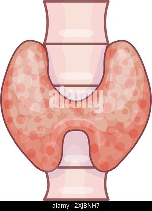 Illustration einer menschlichen Schilddrüse mit Autoimmunerkrankung, die ein vergrößertes und entzündetes Aussehen zeigt Stock Vektor