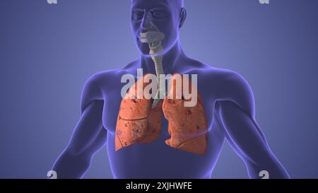 Das medizinische Konzept der Lungenpneumothorax-Erkrankung Stockfoto