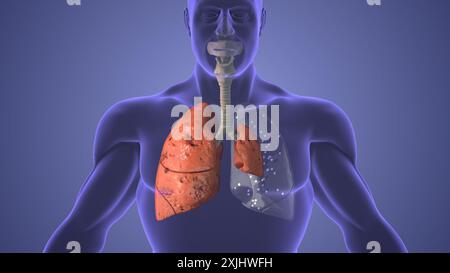 Das medizinische Konzept der Lungenpneumothorax-Erkrankung Stockfoto