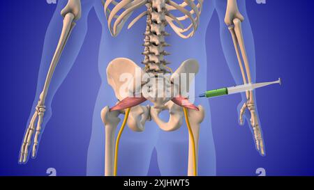 Injektion von Steroiden zur Behandlung des Piriformis-Syndroms Stockfoto