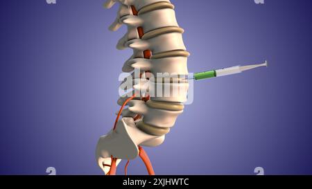 Injektion von Steroiden zur Behandlung von Bandscheibenvorfällen Stockfoto
