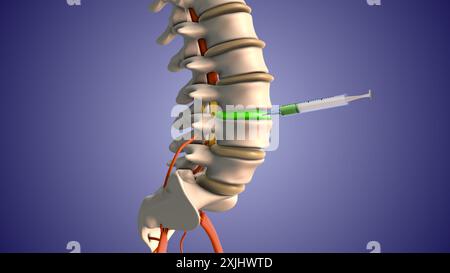 Injektion von Steroiden zur Behandlung von Bandscheibenvorfällen Stockfoto