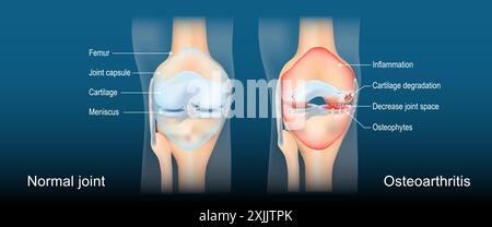 Osteoarthritis. Arthritis ist eine degenerative Gelenkerkrankung. Entzündung, Schwellung und Gelenkschmerzen. Vorderansicht des menschlichen Kniegelenkes mit leuchtender Wirkung. Stock Vektor