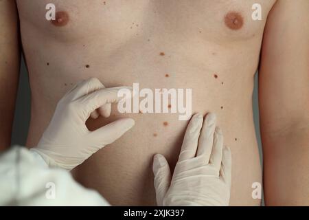 Dermatologe in Handschuhen zur Untersuchung der Muttermale des Patienten, Nahaufnahme Stockfoto