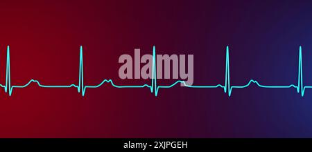 Abbildung eines Elektrokardiogramms (EKG) mit verlängertem QT-Intervall mit gekerbter und niedrigerer Amplitude, charakteristisch für das Long-QT-Syndrom Typ 2. Das Long-QT-Syndrom ist eine erbliche Herzerkrankung, die den Herzschlag beeinflusst und manchmal Ohnmacht oder Krampfanfälle verursachen kann. Stockfoto