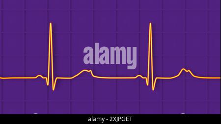 Abbildung eines Elektrokardiogramms (EKG) mit verlängertem QT-Intervall mit gekerbter und niedrigerer Amplitude, charakteristisch für das Long-QT-Syndrom Typ 2. Das Long-QT-Syndrom ist eine erbliche Herzerkrankung, die den Herzschlag beeinflusst und manchmal Ohnmacht oder Krampfanfälle verursachen kann. Stockfoto