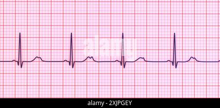 Abbildung eines Elektrokardiogramms (EKG) mit verlängertem QT-Intervall mit gekerbter und niedrigerer Amplitude, charakteristisch für das Long-QT-Syndrom Typ 2. Das Long-QT-Syndrom ist eine erbliche Herzerkrankung, die den Herzschlag beeinflusst und manchmal Ohnmacht oder Krampfanfälle verursachen kann. Stockfoto