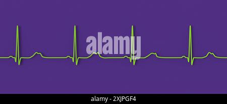 Abbildung eines Elektrokardiogramms (EKG) mit verlängertem QT-Intervall mit gekerbter und niedrigerer Amplitude, charakteristisch für das Long-QT-Syndrom Typ 2. Das Long-QT-Syndrom ist eine erbliche Herzerkrankung, die den Herzschlag beeinflusst und manchmal Ohnmacht oder Krampfanfälle verursachen kann. Stockfoto