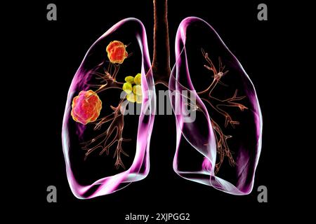 Darstellung der pulmonalen Blastomykose mit Lungenläsionen und vergrößerten Bronchiallymphknoten. Stockfoto