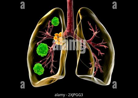 Darstellung der pulmonalen Blastomykose mit Lungenläsionen und vergrößerten Bronchiallymphknoten. Stockfoto