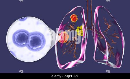 Illustration der pulmonalen Blastomykose mit Lungenläsionen und vergrößerten Bronchiallymphknoten und Nahaufnahme des Pilzes Blastomyces dermatitidis. Stockfoto