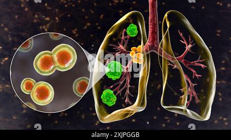 Illustration der pulmonalen Blastomykose mit Lungenläsionen und vergrößerten Bronchiallymphknoten und Nahaufnahme des Pilzes Blastomyces dermatitidis. Stockfoto