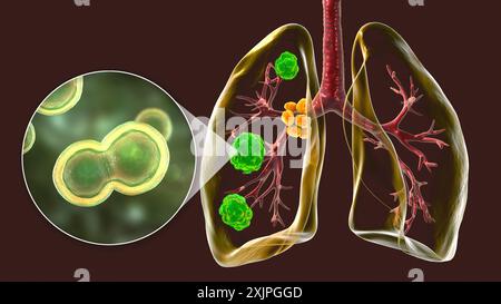 Illustration der pulmonalen Blastomykose mit Lungenläsionen und vergrößerten Bronchiallymphknoten und Nahaufnahme des Pilzes Blastomyces dermatitidis. Stockfoto