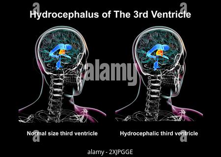 Abbildung: Isolierte Vergrößerung des dritten Hirnventrikels (rechts) im Vergleich zum normalen dritten Ventrikel (links). Stockfoto