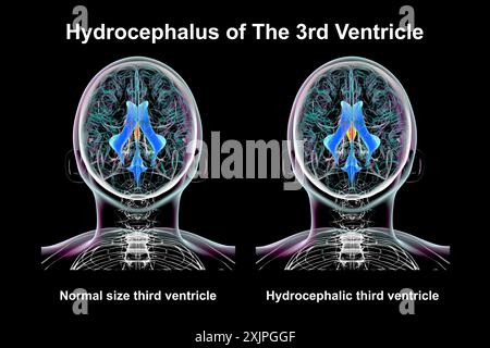 Abbildung: Isolierte Vergrößerung des dritten Hirnventrikels (rechts) im Vergleich zum normalen dritten Ventrikel (links), Draufsicht. Stockfoto