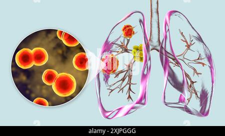 Illustration der pulmonalen Blastomykose mit Lungenläsionen und vergrößerten Bronchiallymphknoten und Nahaufnahme des Pilzes Blastomyces dermatitidis. Stockfoto