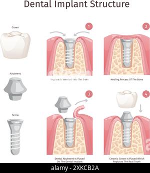 Die dentale Implantatstruktur. Zahnimplantationsverfahren Zahnimplantate Prothesenteile Abutment Kronenbefestigung Schraube Zahnheilkunde medizinisches Diagramm Swanky Vektor Illustration Stock Vektor