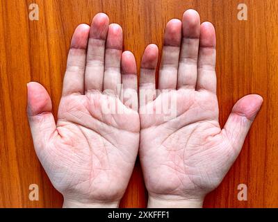 Zyanotische Hände oder periphere Zyanose oder blaue Hände bei südostasiatischen, chinesischen Kind mit angeborener Herzkrankheit. Stockfoto