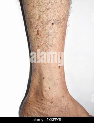 Altersflecken am Bein des asiatischen Älteren. Sie sind braune, graue oder schwarze Flecken und werden auch als Leberflecken, senile Lentigo, Solarlentigine oder Sun sp. Bezeichnet Stockfoto