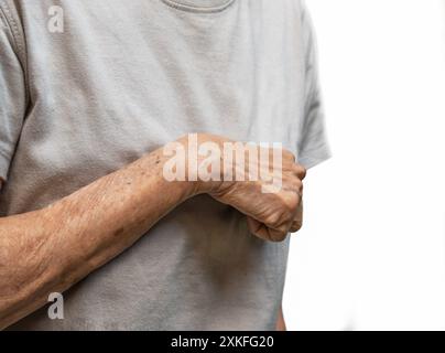 Volkmann-Kontraktur in der linken oberen Extremität einer südostasiatischen Frau. Es ist eine permanente Verkürzung der Unterarmmuskulatur, die zu einem klauenähnlichen Po führt Stockfoto