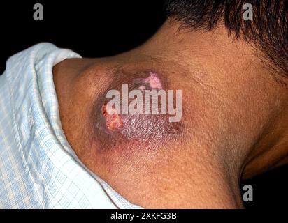 Grosser Abszess mit umgebender Zellulitis oder Staphylokokken-Streptokokken-Hautinfektion am Hals eines asiatischen männlichen Patienten. Stockfoto