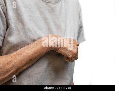 Volkmann-Kontraktur in der linken oberen Extremität einer südostasiatischen Alten. Es ist eine permanente Verkürzung der Unterarmmuskulatur, die zu einem krallenartigen p führt Stockfoto