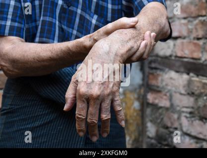 Radiale Nervenverletzung oder Absinken des Handgelenks des älteren Mannes aus Asien. Stockfoto