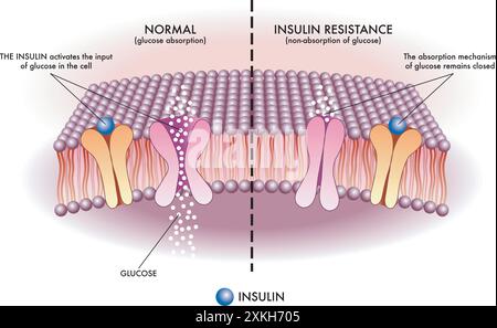 Die medizinische Illustration zeigt auf einfache und schematische Weise den Mechanismus der Insulinresistenz, eine der Ursachen für Typ-2-Diabetes. Stock Vektor