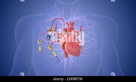 Chemotherapieanschluss mit Katheter in den Körper eingeführt Stockfoto