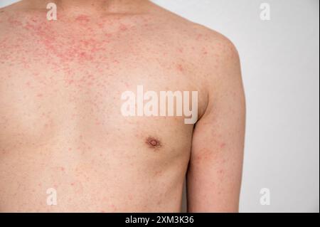 Dermatitis Hautausschlag Viruserkrankung mit Immunschwäche am Körper von jungen erwachsenen asiatischen, Kratzer mit Juckreiz, Masern-Virus, virale Exanthem Stockfoto