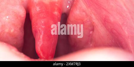 Lange Uvula mit Entzündung von Infektionen und Viren. Die Behandlung der Uvulitis bei Kindern und Erwachsenen. Halsschmerzen, Halsschmerzen. Kopierbereich für Text Stockfoto