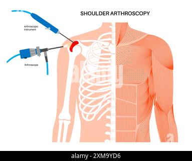 Illustration eines Schulterarthroskopieverfahrens. Dies ist ein Verfahren zur Diagnose und Behandlung von Gelenkproblemen. Ein Chirurg führt einen schmalen Schlauch, der an einer Glasfaser-Videokamera befestigt ist, durch einen kleinen Schnitt ein. Stockfoto
