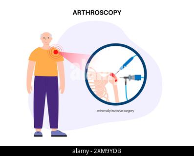Illustration eines Schulterarthroskopieverfahrens. Dies ist ein Verfahren zur Diagnose und Behandlung von Gelenkproblemen. Ein Chirurg führt einen schmalen Schlauch, der an einer Glasfaser-Videokamera befestigt ist, durch einen kleinen Schnitt ein. Stockfoto