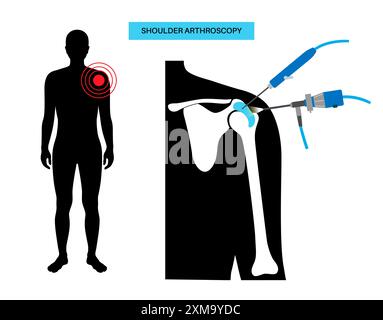 Illustration eines Schulterarthroskopieverfahrens. Dies ist ein Verfahren zur Diagnose und Behandlung von Gelenkproblemen. Ein Chirurg führt einen schmalen Schlauch, der an einer Glasfaser-Videokamera befestigt ist, durch einen kleinen Schnitt ein. Stockfoto