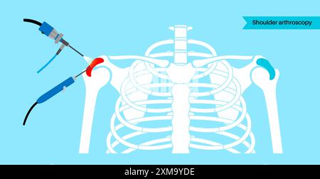 Illustration eines Schulterarthroskopieverfahrens. Dies ist ein Verfahren zur Diagnose und Behandlung von Gelenkproblemen. Ein Chirurg führt einen schmalen Schlauch, der an einer Glasfaser-Videokamera befestigt ist, durch einen kleinen Schnitt ein. Stockfoto