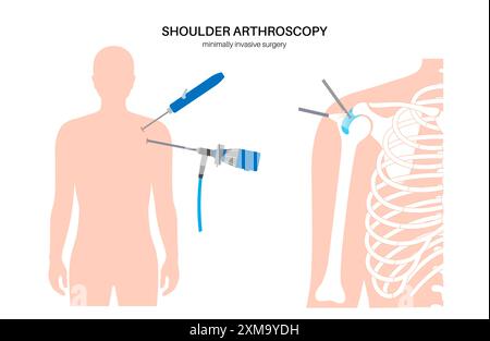 Illustration eines Schulterarthroskopieverfahrens. Dies ist ein Verfahren zur Diagnose und Behandlung von Gelenkproblemen. Ein Chirurg führt einen schmalen Schlauch, der an einer Glasfaser-Videokamera befestigt ist, durch einen kleinen Schnitt ein. Stockfoto